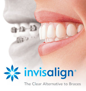 Skopek Orthodontics invisalign clear aligners