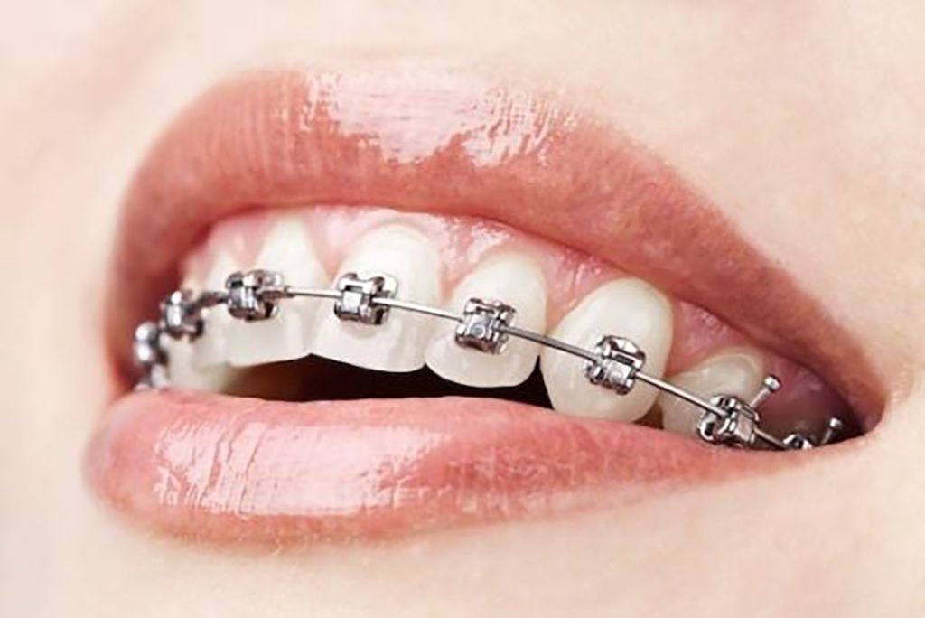 Skopek Orthodontics metal braces services