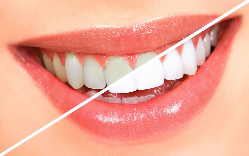 skopek orthodontics teeth whitening north barrington il