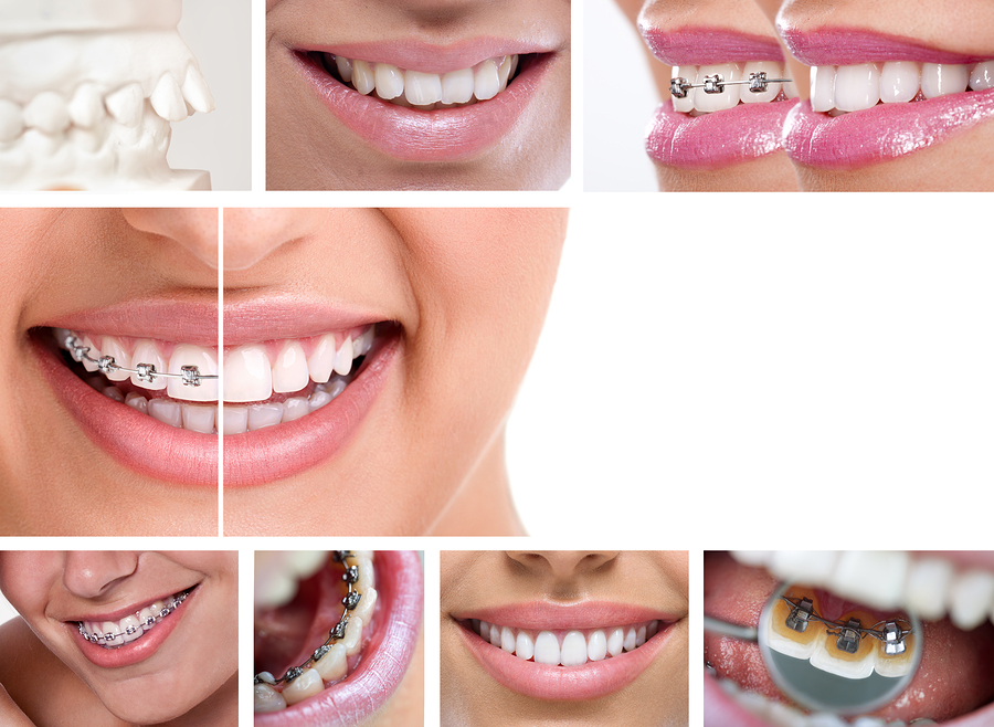 Metal braces and lingual braces services from Skopek Orthodontics