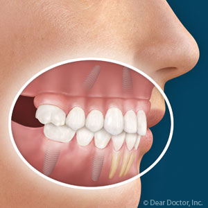 Skopek Orthodontics natural tooth with dental implants