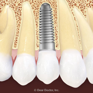 Premolar dental implant Skopek Orthodontics
