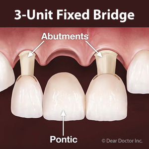 3-unit Fixed bridge Skopek Orthodontics