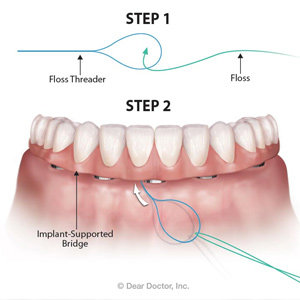Flossing implant bridge Skopek Orthodontics