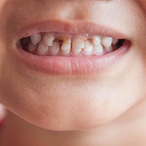 Skopek Orthodontics kids tooth decay