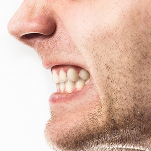 Skopek Orthodontics man grinding his teeth