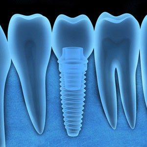 Skopek Orthodontics dental implant