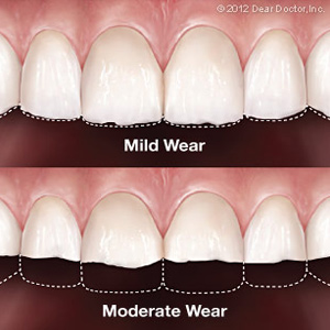 Skopek Orthodontics tooth wear