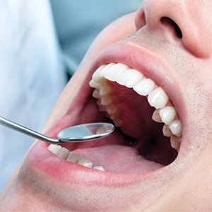 Skopek Orthodontics examining for tooth decay